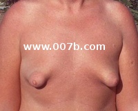 Breast Gallery - not normal breasts: surgically altered ...