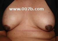 male breast growth