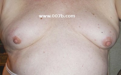 Tits Tubular Deformed Breasts - Breast Gallery - not normal breasts: surgically altered ...