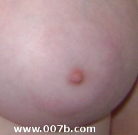 200px x 196px - Pictures of normal nipples. The bumps on areola are ...